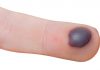 blood blister on finger