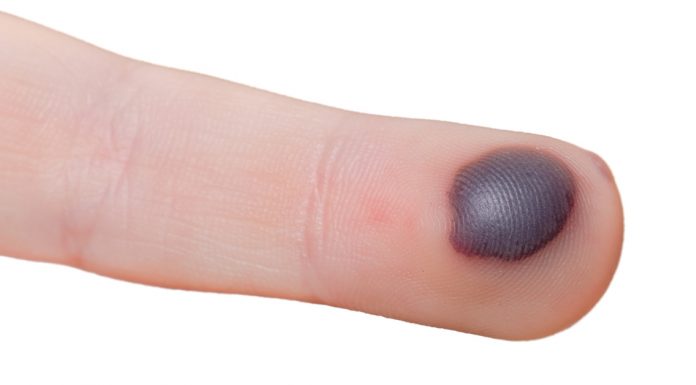 blood blister on finger