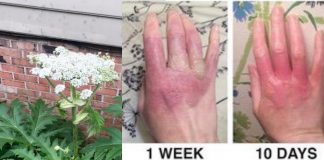 hogweed plant causes burns and blindness
