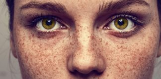 what causes freckles