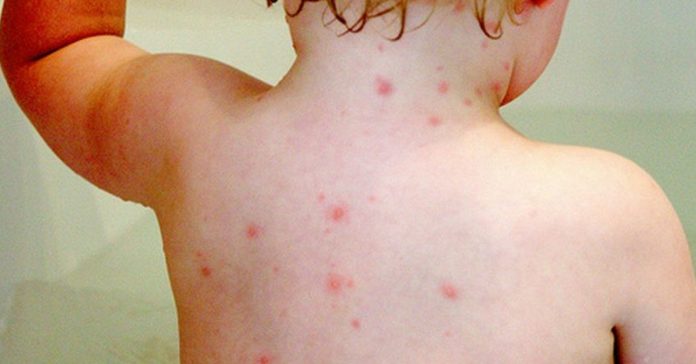stroke-after contracting chicken pox