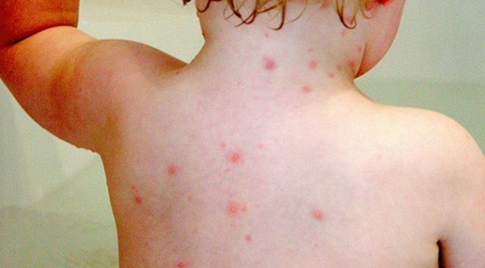 stroke-after contracting chicken pox