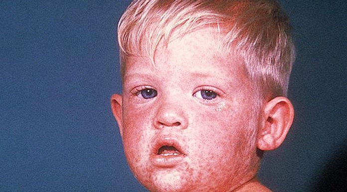 measles outbreak in 21 states