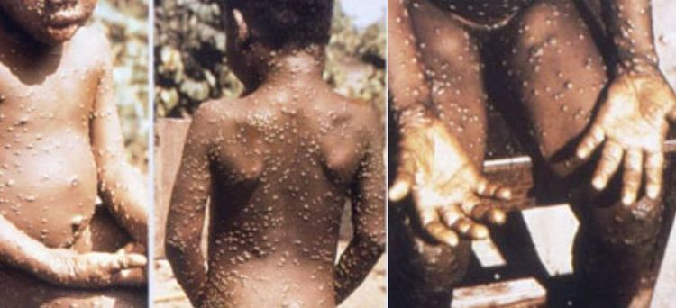 Rare Monkeypox Virus Has Started Reappearing | Health Sumo