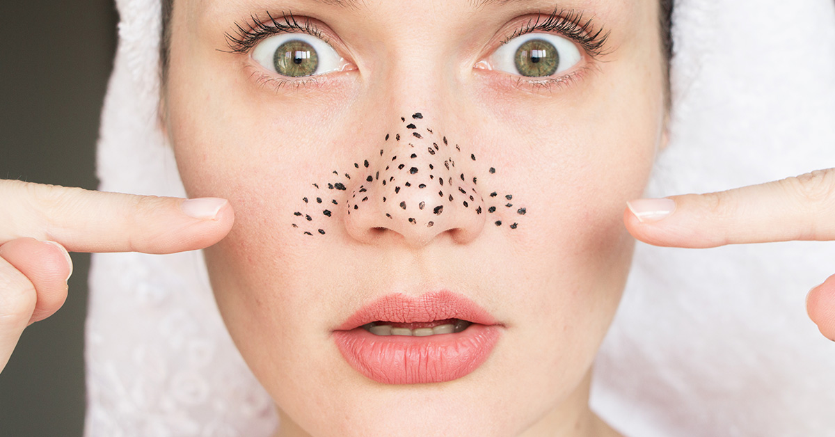 Blackhead Removal: How To Get Rid Of Blackheads Easily