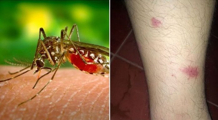 mosquito bites skeeter syndrome