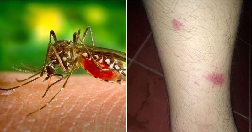 You May Have ‘skeeter Syndrome If Your Mosquito Bites Sting And Swell