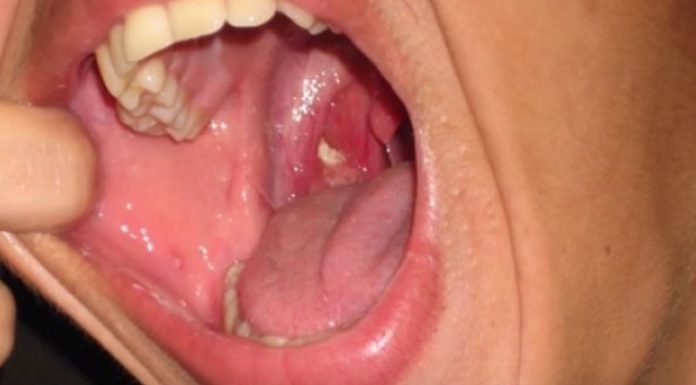 bad breath tonsil stones