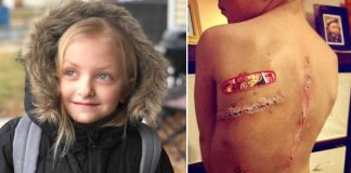 Little Girl's Cancer Scars