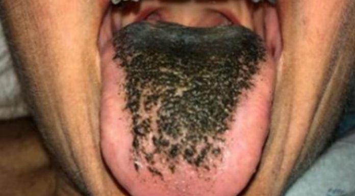 black hairy tongue