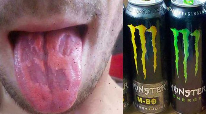 tongue eaten away energy drinks